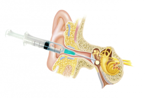 Intratympanic injection of cortisone for sudden hearing loss | Polyclinique  Centre-Ville