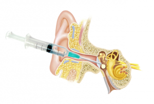 Injection de cortisone intratympanique pour la surdité subite ...