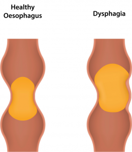 dysphagia_245355787.jpg