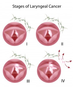 laryngeal cancer_118506340