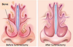 turbinectomy